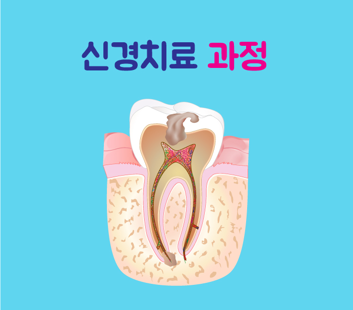 신경치료5