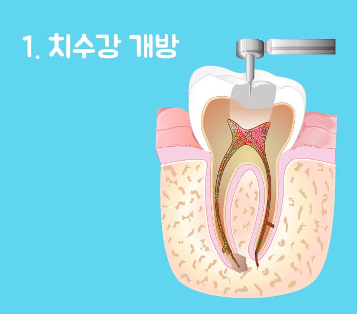 신경치료6