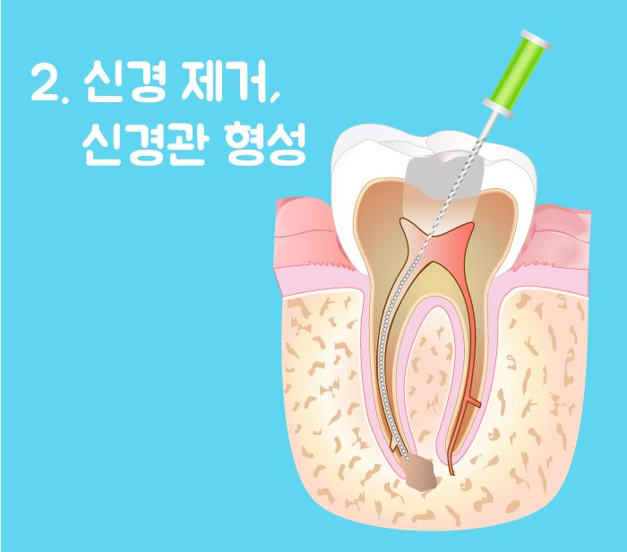 신경치료7