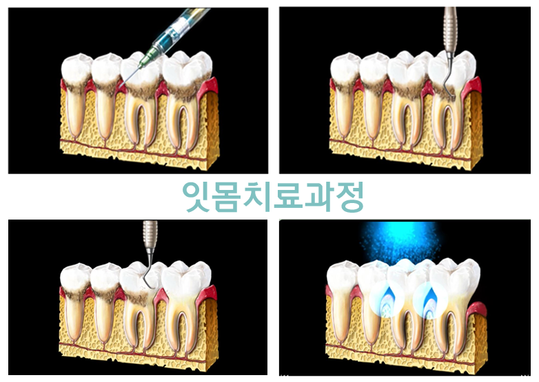 잇몸치료-과정