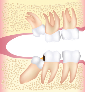 사랑니-04
