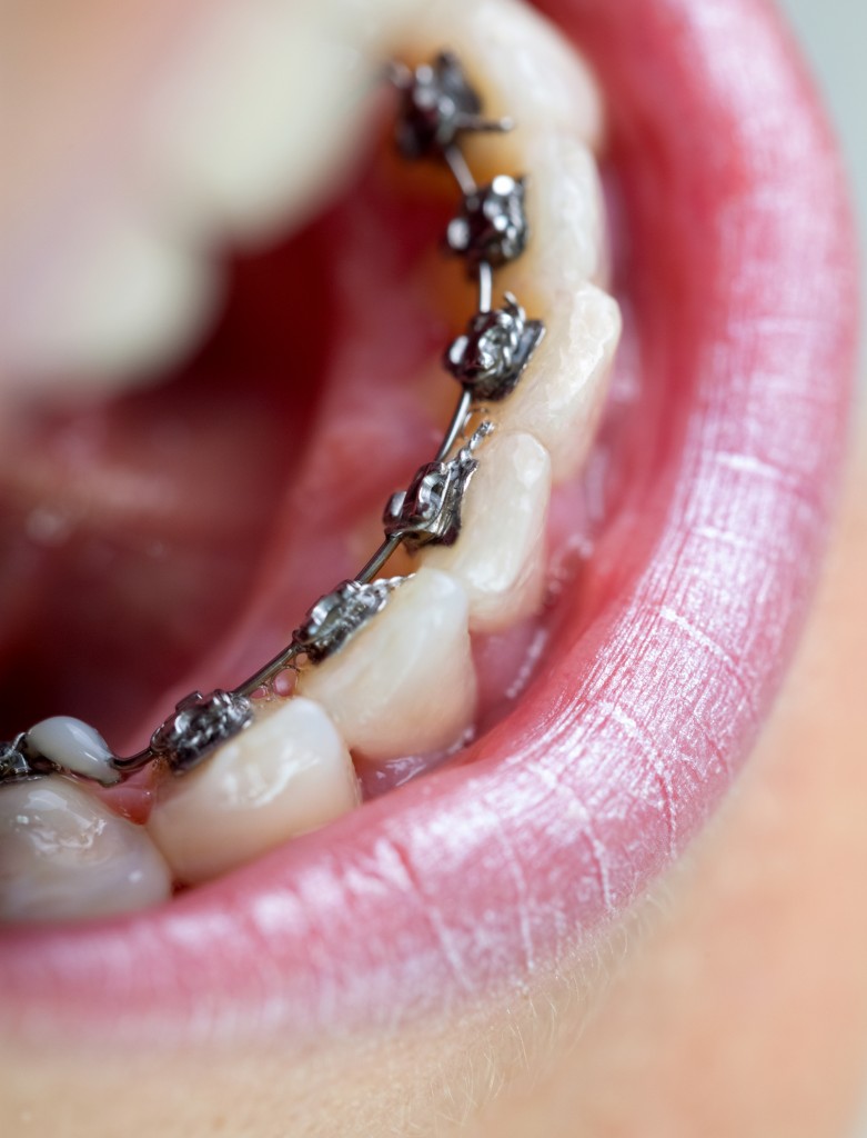 Young woman with lingual braces