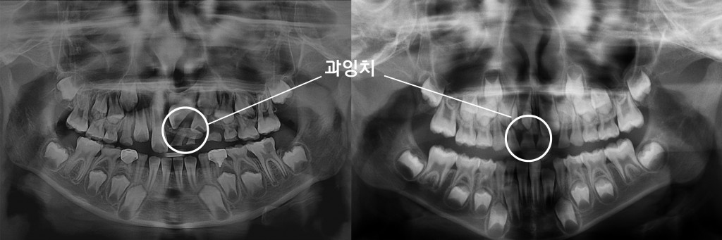 엑스레이2장-1