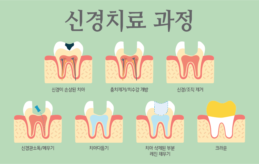 신경치료과정