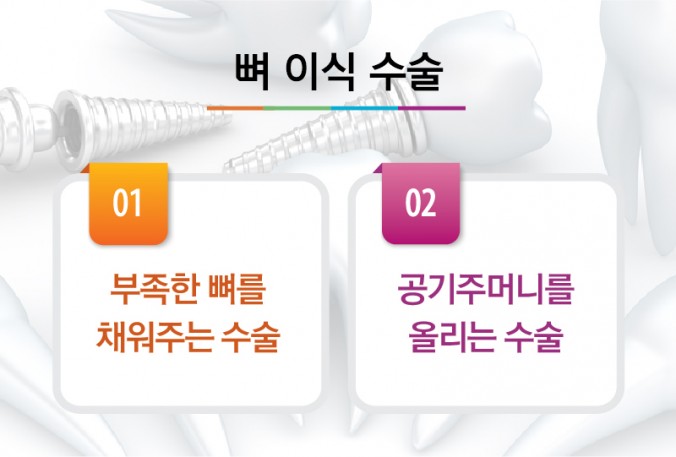 [울산임플란트] 임플란트 뼈 이식 제대로 알고 받자!!울산치과 한빛치과병원 | 울산치과 한빛치과병원