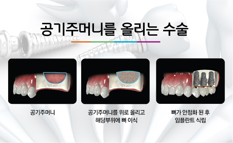 [울산임플란트] 임플란트 뼈 이식 제대로 알고 받자!!울산치과 한빛치과병원 | 울산치과 한빛치과병원